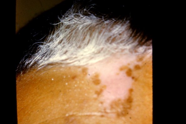 Piebaldism Piebaldism Comprehensive Dermatology Photo Atlas Wayne